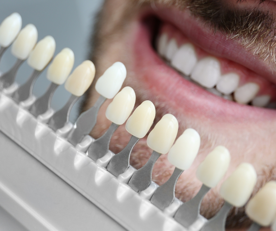 A close-up of a dentist applying dental veneers to transform a patient's smile.